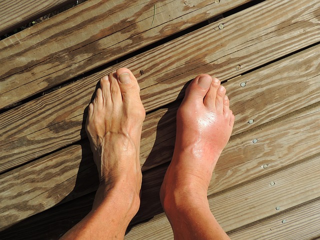 A pair of feet, with the left foot appearing normal and healthy, while the right foot is severely inflamed and swollen, indicating a potential medical condition. Stock image by cnick from Pixabay.